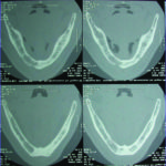 Fig. 15 TC Dentascan prima della chirurgia implantare.
