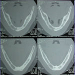 Fig. 15 TC Dentascan prima della chirurgia implantare.