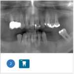 Fig. 2 Ortopanoramica iniziale del paziente dove si evidenziano le sofferenze parodontali