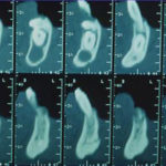 Fig. 2 TC Dentascan prima dell’intervento.