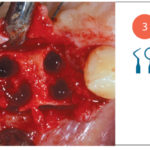 Fig. 3 Osteotomie sul lato sinistro  prima dell’inserimento degli impianti.