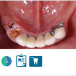 Fig. 3 Situazione clinica iniziale: visione occlusale