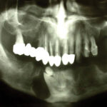 Fig. 3 Ortopantomografia dopo bonifica dentaria.