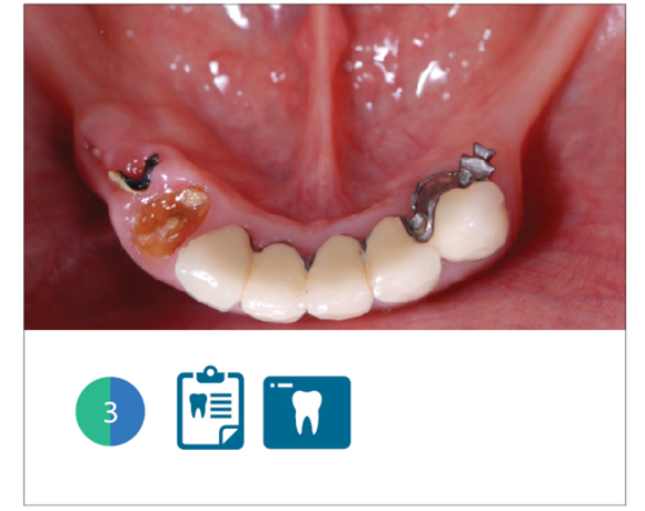 Fig. 3 Situazione clinica iniziale: visione occlusale
