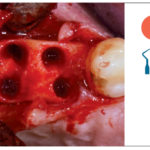 Fig. 4 Osteotomie sul lato destro prima dell’inserimento degli impianti.