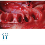 Fig. 5 Avulsione degli elementi dentari e scheletrizzazione ossea.