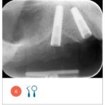Figg. 6 Lato destro dopo l‘inserimento degli impianti.