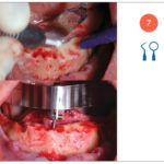 Fig. 7 Osteotomia ed applicazione della Just-Guide.