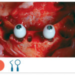Fig. 9 Impianti inseriti secondo la metodica Just On 4.