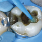 Fig. 7 Applicazione dell’agente adesivo Futurabond M+ su smalto e dentina con un microbrush.