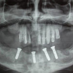 Fig. 16 Ortopantomografia dopo chirurgia implantare.