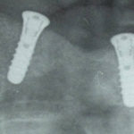 Figg. 17 e 18 Dettaglio ortopantomografia dopo chirurgia implantare .