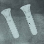 Figg. 17 e 18 Dettaglio ortopantomografia dopo chirurgia implantare .