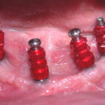 Fig. 20 Protocollo protesico-riabilitativo.