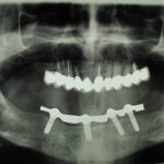 Fig. 25 Ortopantomografia dopo 7 anni .