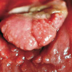 Fig. 2 Lesione prima dell’exeresi, aprile 2013.