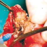 Fig. 4 Exeresi della lesione.