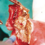 Fig. 5 Exeresi della lesione.