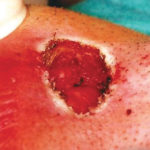 Fig. 6 Post exeresi (visione extra orale).