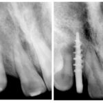 Fig. 11 La radiografia prima e dopo l’inserimento dell’impianto.