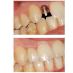 Fig. 12 La modellazione della mucosa perimplantare dopo la rimozione del provvisorio cementato al momento del termine dell’intervento. Sotto: il dente definitivo in metallo-ceramica.
