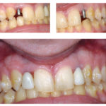 Fig. 5 I due impianti inseriti con tecnica “flapless” parallelizzati e i due provvisori immediati al termine della chirurgia.