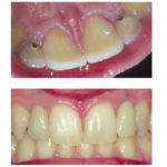 Fig. 8 Ulteriore follow-up con la visione dell’aspetto mucoso sia palatale che vestibolare.