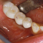 protesi fissa definitiva fissata alla struttura implantare