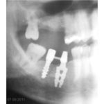 Radiografia post-operatoria