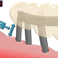 Fig. 55 Protesi distanziata dalle mucose su saldatura alta.