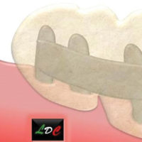 Fig. 54 Protesi a contatto con le mucose su saldatura bassa.