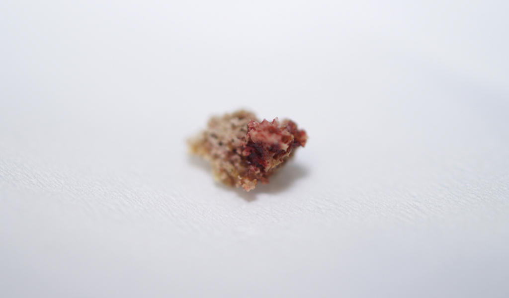 Osteonecrosi da bifosfonati