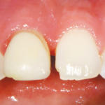 rigenerazione-ossea-1