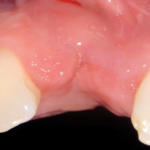 rigenerazione-ossea-10