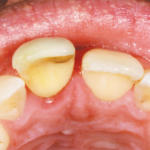 rigenerazione-ossea-2