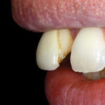 rigenerazione-ossea-3