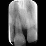 rigenerazione-ossea-4