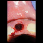 rigenerazione-ossea-5