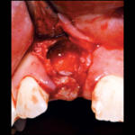 rigenerazione-ossea-6