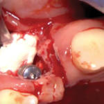 rigenerazione-ossea-7