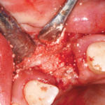 rigenerazione-ossea-8