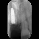 rigenerazione-ossea-9