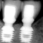 Due-impianti-con-il-dettaglio-del-platform-switching.