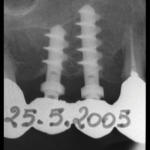 Due-viti-bifasiche-di-Muratori