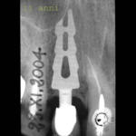 apposizione-del-tessuto-osseo