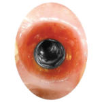 mucosa-attorno-alla-connessione-implantare