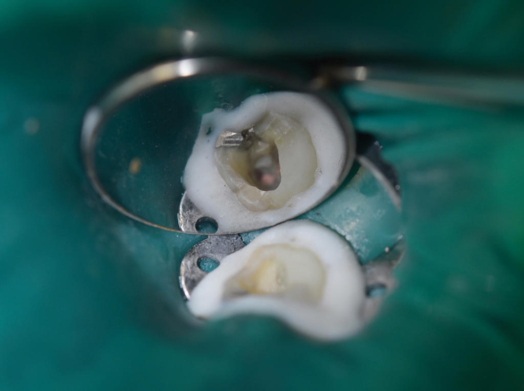 endodonzia