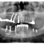 Ortopantomografia post trattamento chirurgico