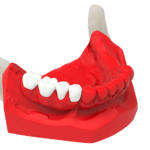 Determinazione dei volumi protesici