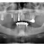 impianti sottoperiostei